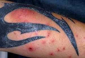  аллергия на татуировку лечение