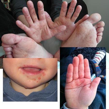 Сыпь на подошве стопы у детей лечение thumbnail