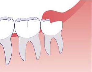 удаление зуба мудрости на нижней челюсти