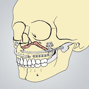 удаление зуба на верхней челюсти