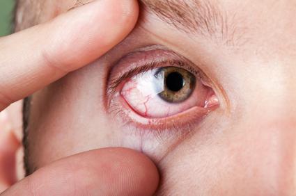 роговица глаза поражается при нехватке витамина
