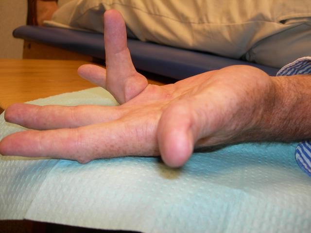 Уплотнения на ладонях рук лечение народными средствами thumbnail