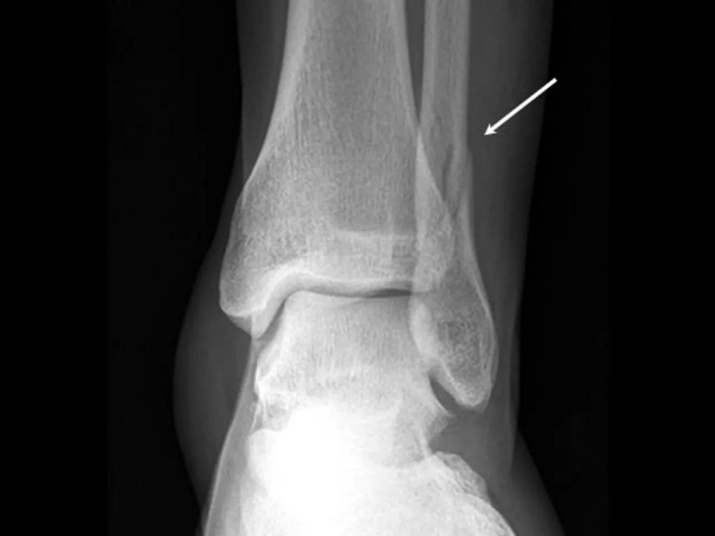 Малоберцовая кость смещение. Малая берцовая кость перелом. Оскольчатый перелом малоберцовой кости. Перелом малой берцовой кости. Краевой перелом эпифиза малой берцовой кости.