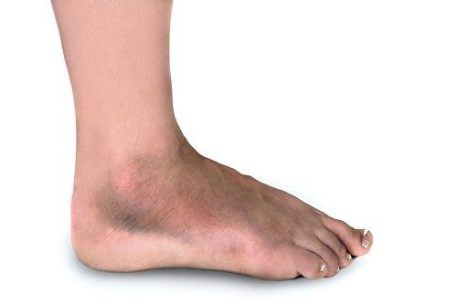 Симптомы перелома ноги стопы фото thumbnail