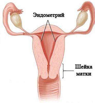 гиперплазия эндометрия отзывы