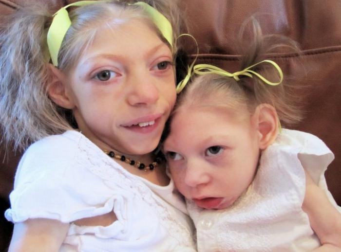 the rarest diseases in the world