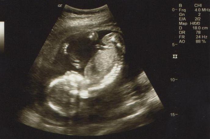 Фото двойни на узи 7 недель беременности