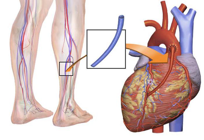 шунтирование сердца сколько живут после операции