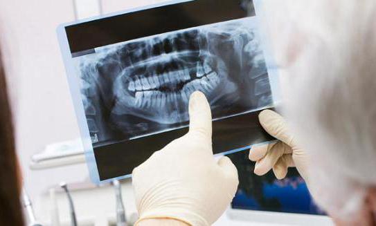 киста зуба на рентгеновском снимке 