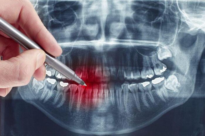 рентгеновский снимок зуба расшифровка