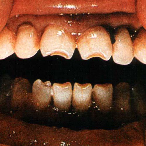 зубы гетчинсона