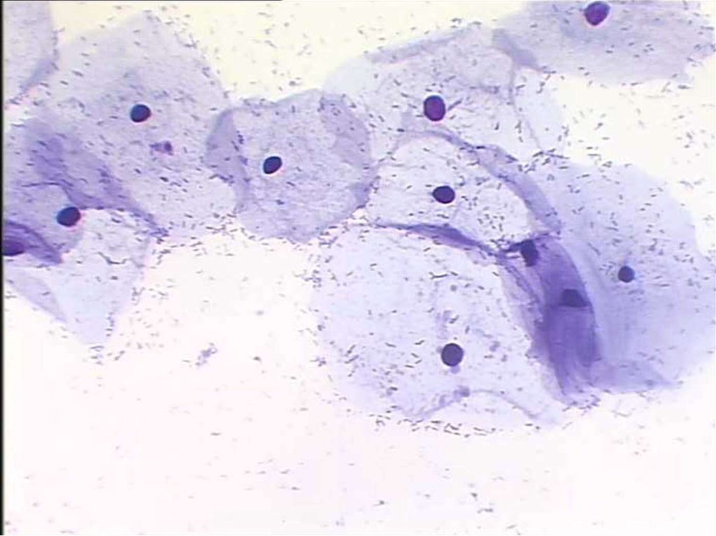 Цитология клеток шейки матки. Палочки Дедерлейна микроскопия. Хламидиоз микроскопия мазка. Плоский эпителий цитология.
