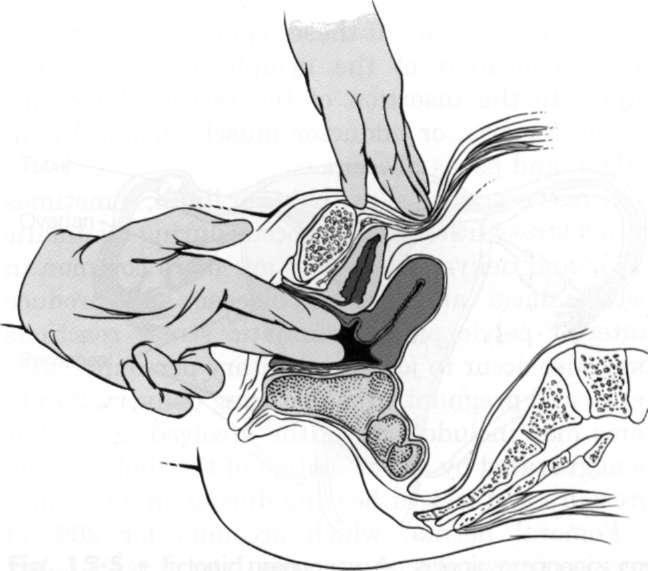 ретрофлексия матки фото