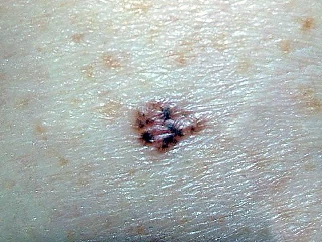базально клеточный рак кожи начальная стадия фото