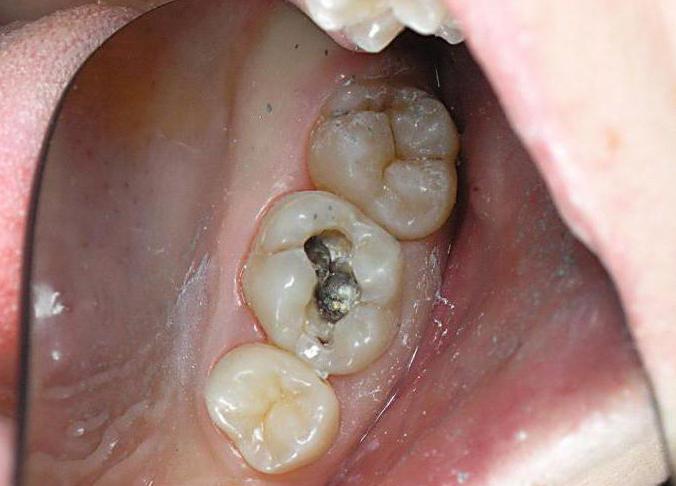 лечение пульпита зуба этапы