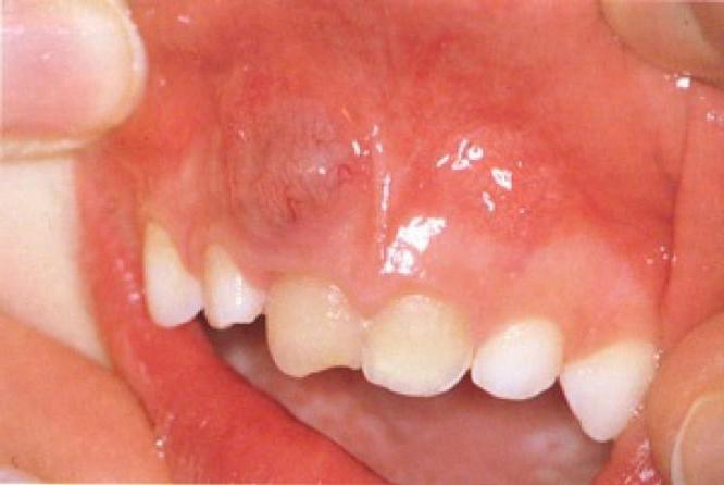 можно ли вылечить кисту зуба без удаления