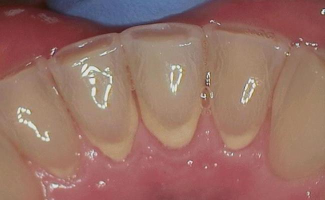 виды зубных отложений