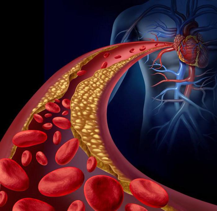 тромбоэмболия артерий нижних конечностей