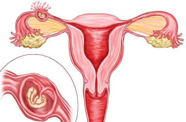Как выглядит спираль против беременности в матке 22
