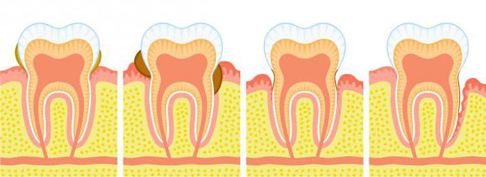 Лечение пародонтоза и зубов народными средствами в домашних условиях thumbnail