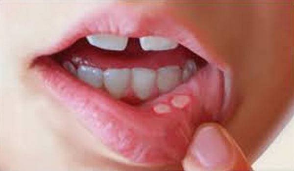 Бактериальный стоматит у ребенка лечение thumbnail