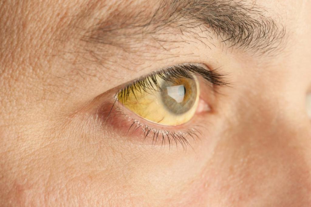 Желтушность кожных покровов и склер глаз