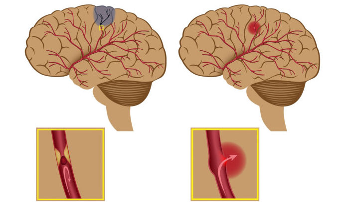 Тромб в сосудах головного мозга