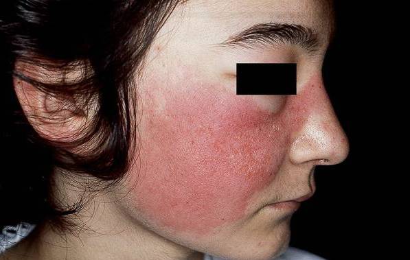 Туберкулез кожи фото начальная стадия 26