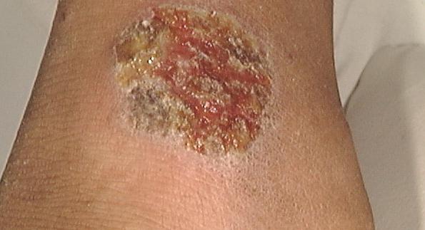 leishmaniasis photo