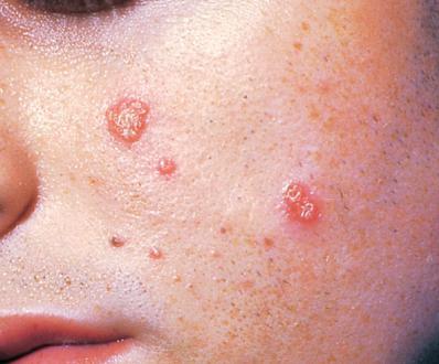 visceral leishmaniasis symptoms