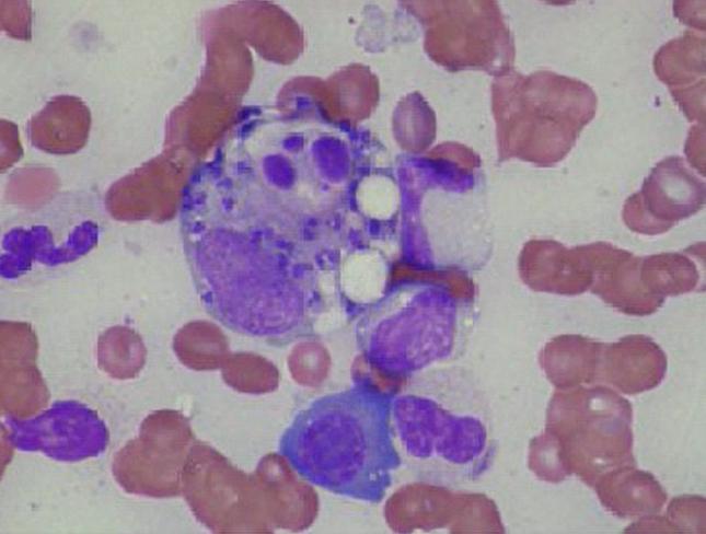 leishmaniasis diagnosis