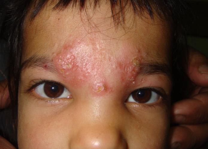 leishmaniasis disease