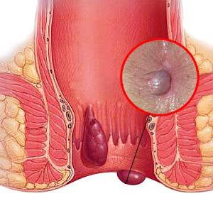 лечение наружного геморроя у женщин