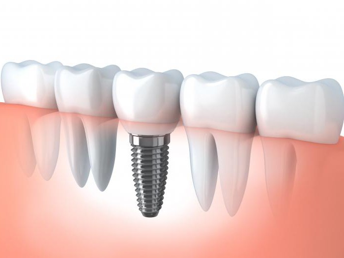 вкладки в зубы при протезировании
