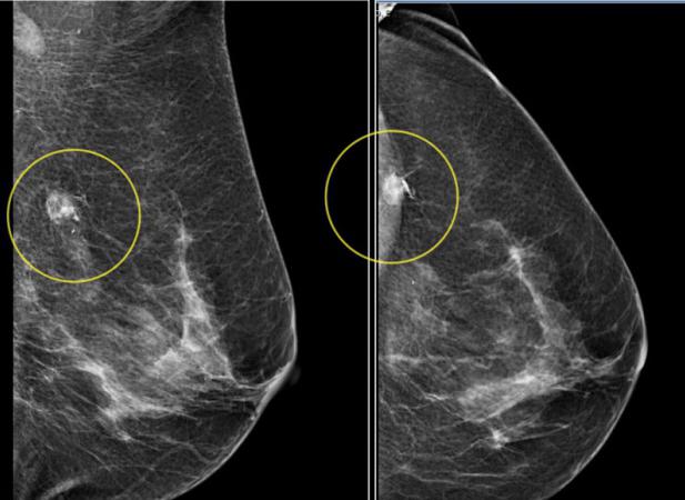 цифровая маммография