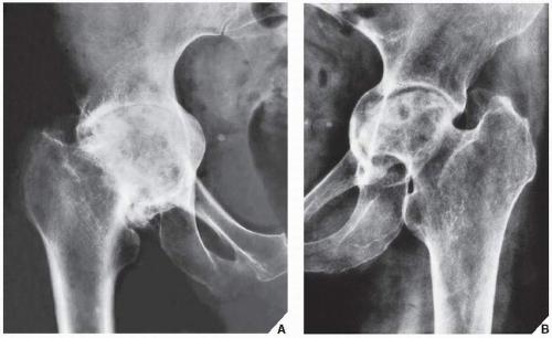 Стадии коксартроза тазобедренного сустава по рентгену фото