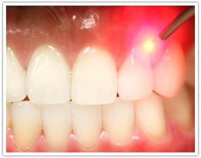 способы удаления зубного налета