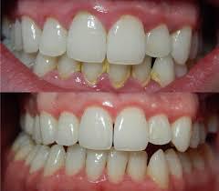 удаление мягкого зубного налета