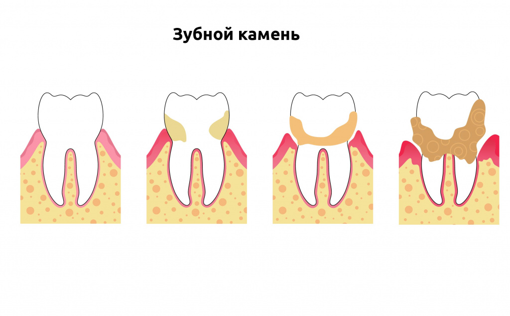 как в домашних условиях убрать камни на зубах