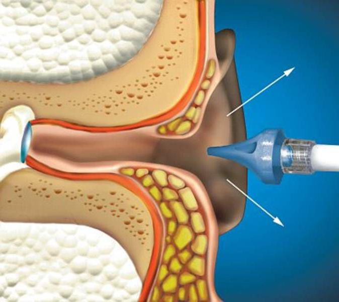 Ирригация в медицине. Устройство для промывания ушного канала.