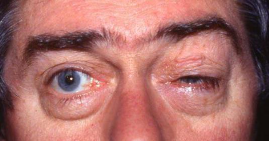 upper orbital fissure syndrome