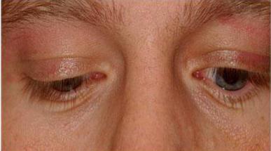 upper palpebral fissure syndrome symptoms