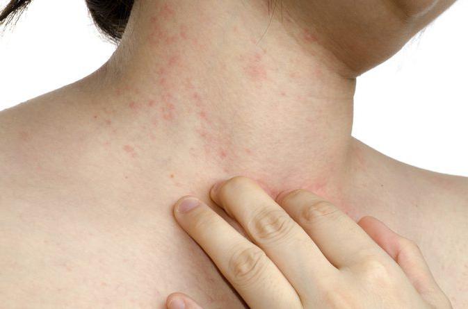 аллергия на шее 