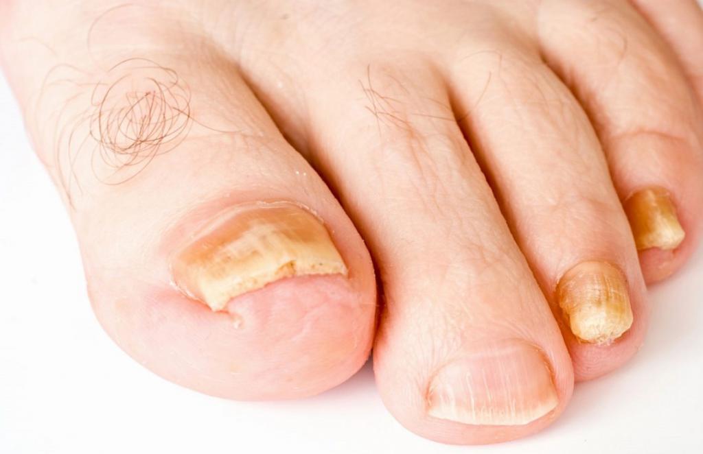 лечить грибок ногтей ног народными средствами