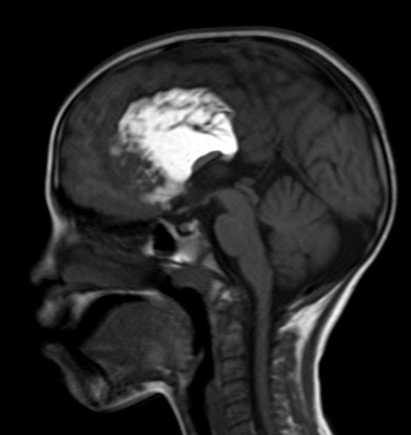 MRI brain lipoma