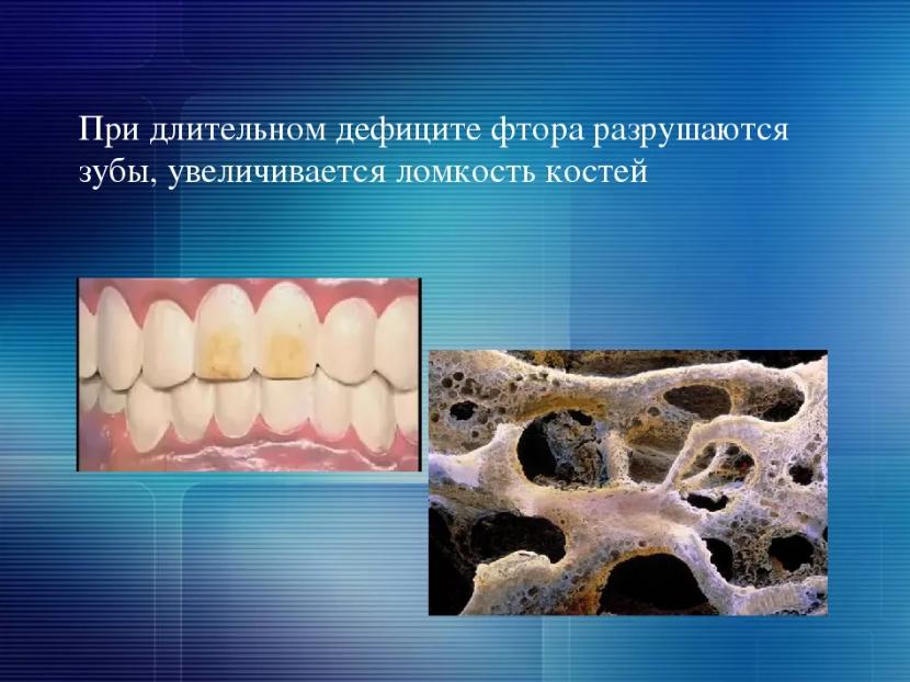 Длительный избыток фтора может привести к развитию. Заболевания связанные с недостатком фтора. Избыток фтора в организме человека. Нехватка фтора в организме. Разрушение зубов и костей.
