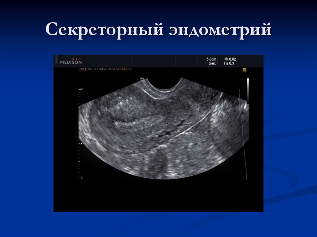 Виды эндометрия. УЗИ ранняя секреторная фаза. Секреторный эндометрий. Секреторный Тип эндометрия. Секреторный эндометрий по УЗИ.