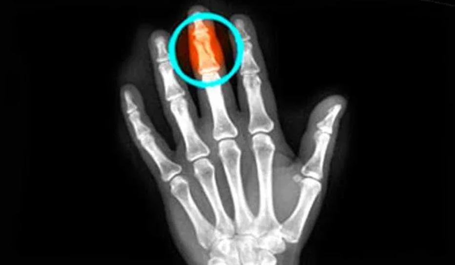 Трещина фаланги. Рентген перелома средней, фаланги мизинца руки. Перелом средней фаланги пальца на руке рентген. Рентген перелома пальца мизинца. Рентген перелома фаланги большого пальца руки.