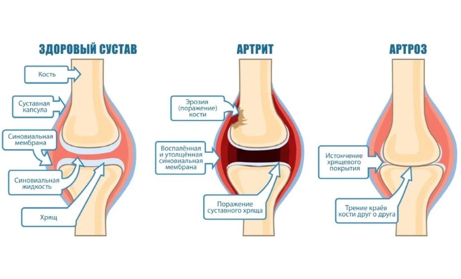 Артроз симптомы и лечение