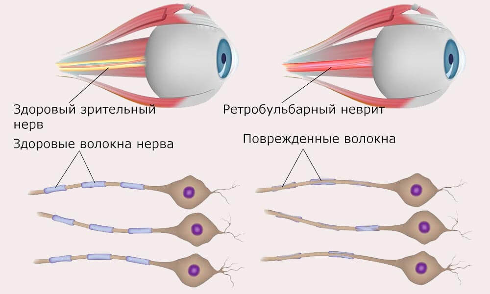 Ретробульбарный неврит зрительного нерва: